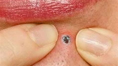 Large pimple popping video. The latest video we came across—shared by Michael Lewis, M.D.—shows Lewis slicing open a considerable cyst before popping its contents out like they were shot out of a cannon. Though the cyst ... 