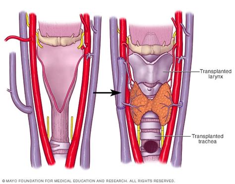 Larynx and Trachea Transplant Program in Arizona Overview Mayo Clinic