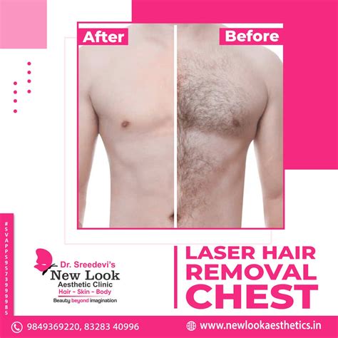 Laser Chest Hair Removal - Reveal a Sleek, Hair-Free Look