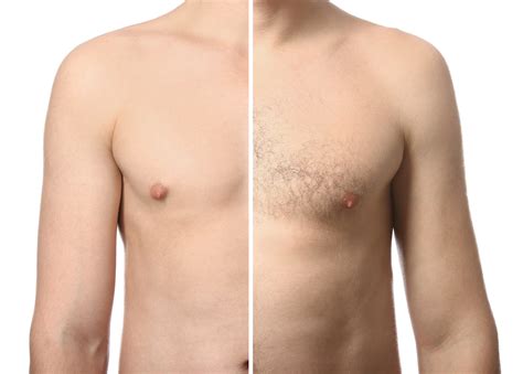 Laser Hair Removal for Men: An Overview - Genesis Cosmetic …