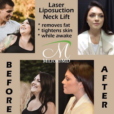 Laser Liposuction MilfordMD Cosmetic Dermatology