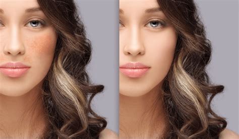 Laser Skin Pigmentation Removal in Mumbai Bombay Cosmetic Clinics