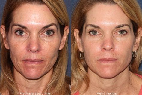 Laser Skin Tightening: Treating Fine Lines and Wrinkles