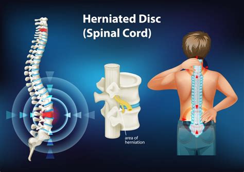 Laser disc surgery – a new treatment for slipped disc - Top Doctors