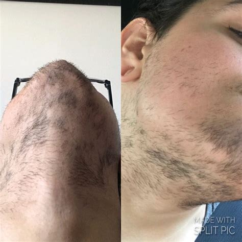 Laser hair removal reddit. Sessions should be spaced out every 4-6 weeks, so it takes time. And estrogen makes your skin thinner so it could be more painful after starting HRT. I started HRT prior to laser hair removal, and as my breasts started getting tender I got motivated to start laser hair removal. I’m 7 sessions in and while the breast area hurts, it’s nothing ... 