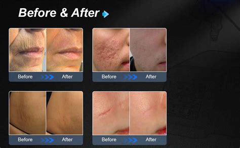 Laser scar removal before and after. .  She provides details about its tech...