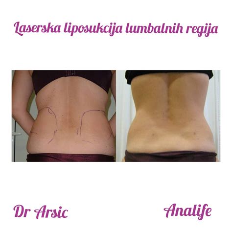 Laserska liposukcija stomaka cena. .  ...