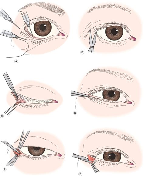 Lateral Tarsal Strip for Ectropion by Mr Richard Caesar