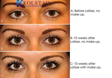 Latisse before and after eyebrows. Be sure to test or consult with your doctor about the concerns before starting the product.” The Ordinary Lash & Brow Serum ($15) and LashFood Eyelash Enhancing Serum ($78) are two options that ... 