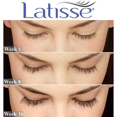 Latisse reviews. Latisse is the only eyelash serum that's backed by research and contains an active ingredient (bimatoprost) known to stimulate hair growth. Originally developed as a treatment for eye pressure, patients who used it noticed a side effect – longer, darker and fuller eyelashes. As a result, the eyelash-enhancing Latisse was launched in the US in ... 