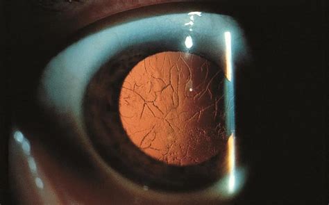 Lattice corneal dystrophy type I: MedlinePlus Genetics