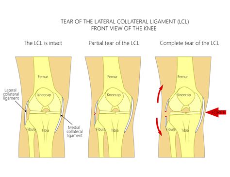 Lcl sprain deutsch