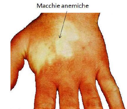 Le macchie dermatologiche - Gastroepato