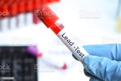 Lead Test To Look for Abnormalities from Blood Stock Photo Image of