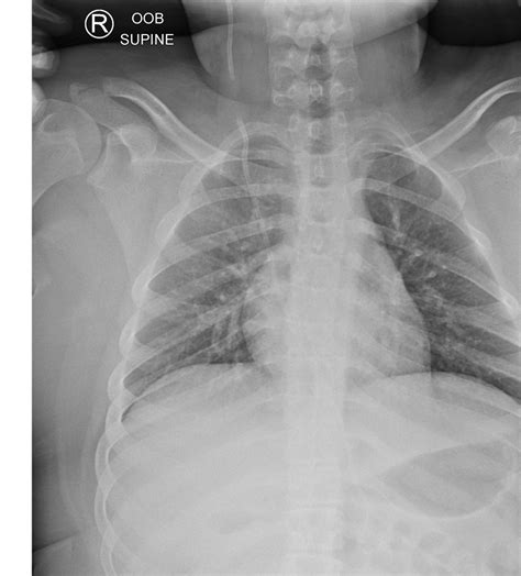 LearningRadiology - Ventriculo-Peritoneal, Shunt, Fracture, …