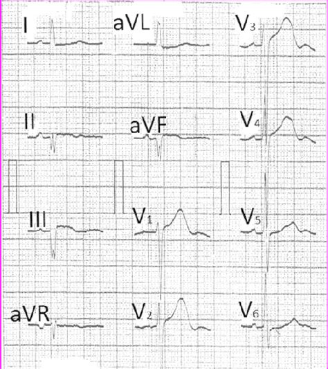 Left Axis Deviation in Inferior Infarction; Vectorcardiographic