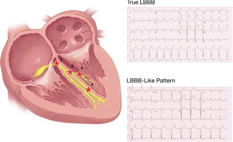 Left Bundle Branch Block - Heart disease - Inspire