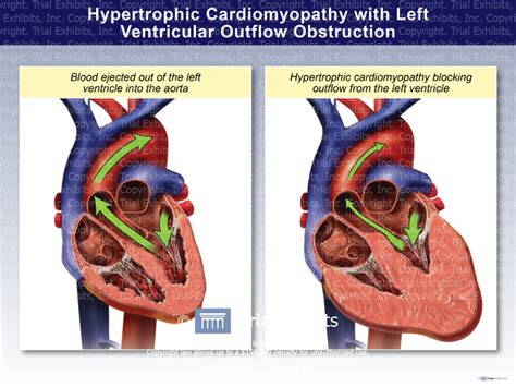 Left Ventricular Outflow Tract Obstruction (LVOTO) • LITFL • CCC