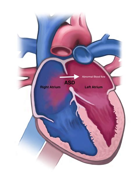 Left atrial-to-right atrial shunt without atrial septal defect or ...