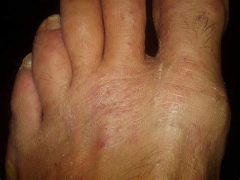 Itchy feet may be caused by athlete’s foot, bug b