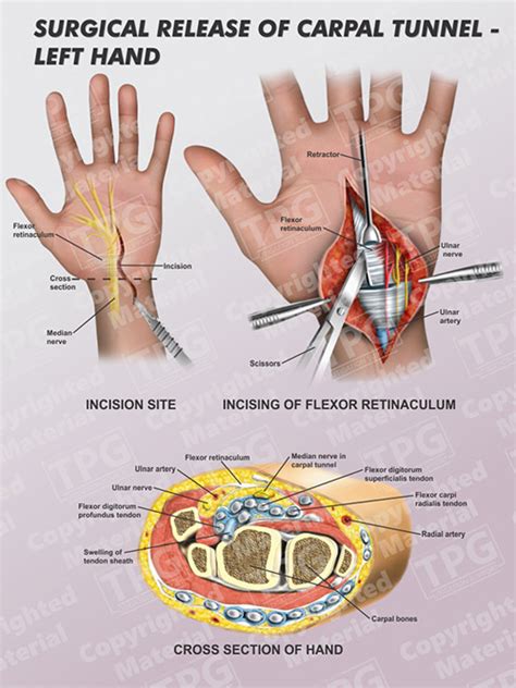 CPT code 64721 describes a neuroplasty and/or transposition of the median nerve at the carpal tunnel and includes open release of …