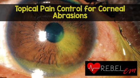 Search Results. 500 results found. Showing 1-25: ICD-10-CM Diagnosis Code S05.0. Injury of conjunctiva and corneal abrasion without foreign body. Injury of conjunctiva and corneal abrasion w/o foreign body; foreign body in conjunctival sac (T15.1); foreign body in cornea (T15.0) ICD-10-CM Diagnosis Code S05.00XA [convert to ICD-9-CM] Injury of ...