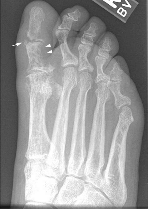 Subacute osteomyelitis, unspecified ankle and foot. M86.279 is a billable/specific ICD-10-CM code that can be used to indicate a diagnosis for reimbursement purposes. The 2024 edition of ICD-10-CM M86.279 became effective on October 1, 2023. . 