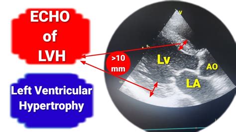 Left ventricular hypertrophy - YouTube