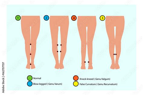 Leg Shape & Size Overview - Causes, Treatment Options, and …