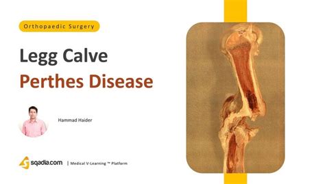 Legg-Calve-Perthes Disease OrthoPaedia