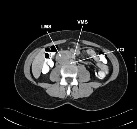 Leiomyosarcoma of the Inferior Vena Cava: Clinicopathologic