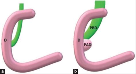 Lemmel’s Syndrome: A Rare Cause of Obstructive …