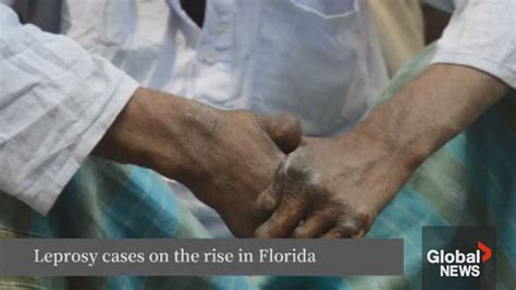 Leprosy could become endemic in Florida as cases rise, CDC says