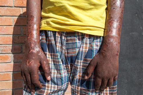 Leprosy warning issued by CDC for people traveling in Florida
