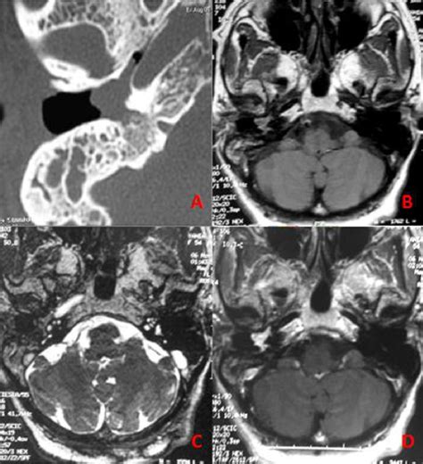 Lesions of the petrous apex: an algorithmic diagnostic approach