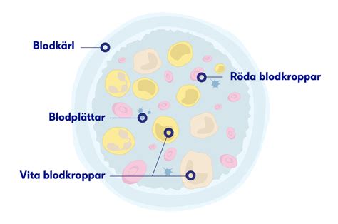 Leukemi &ndash; Symtom, orsaker och behandling: Cancerfonden