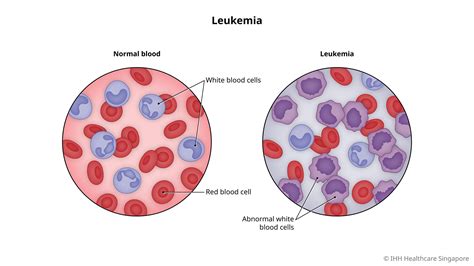 Leukemia how is it diagnosed