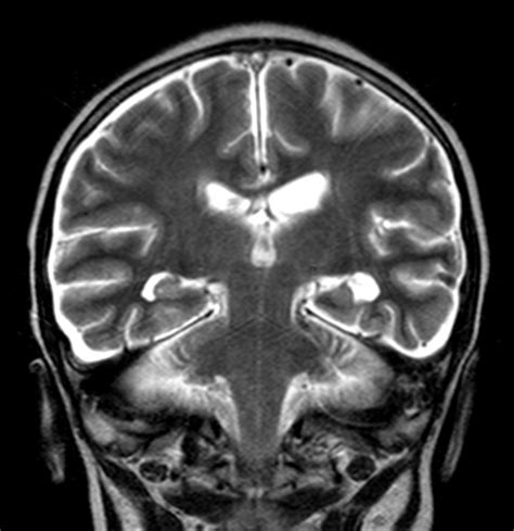 NM is diagnosed in 1%–5% of patients with solid tumors (in which case it is termed carcinomatous meningitis and the main subject of this review), 5%–15% of patients with leukemia (termed leukemic meningitis) and lymphoma (termed lymphomatous meningitis), and 1%–2% of patients with primary brain tumors .. 