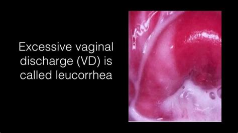 Leukorrhea pictures. It is the secretion of a transparent fluid or the mucus, which keeps the vagina moist and lubricated, and prevents vaginal infections. Leucorrhoea occurs due to fluctuations in hormonal levels during a woman's adult life from puberty to menopause. Symptoms of leucorrhoea, such as a non-itchy white discharge and a feeling of wetness, are ... 