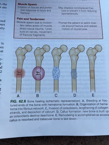 Lewis Chap 62 Fractures Flashcards Quizlet