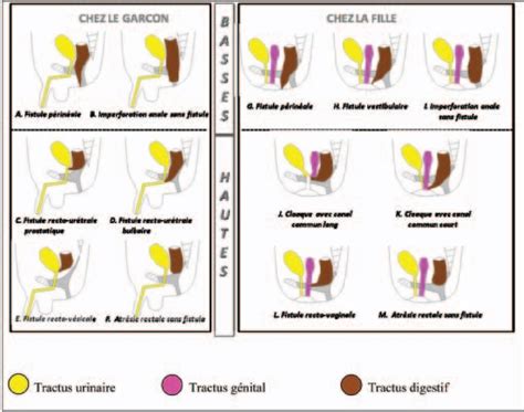 Lexique des malformations ano-rectales