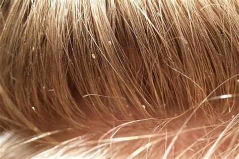 Lice In Blonde Hair: How It Looks Like and What To Do With It