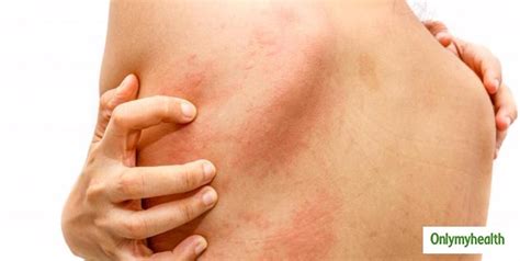 Limonene allergy what to avoid.  What should I do to avoid Balsam of P...