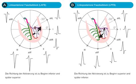 Linksanteriorer Hemiblock – biologie-seite.de