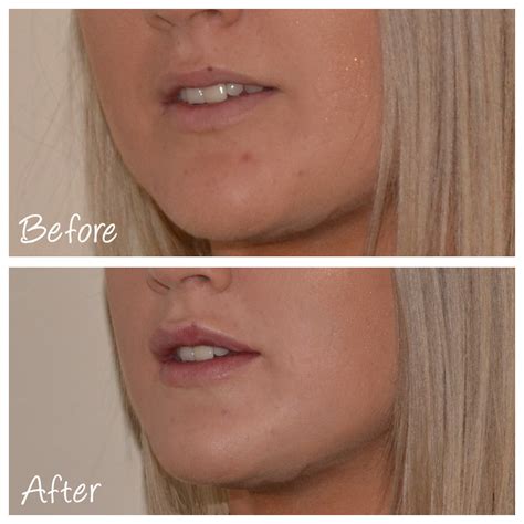 Lip Dermal Fillers & Augmentation Dr. David Sharp