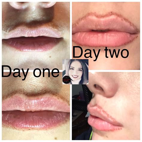 Lip flip before and afters. In recent months we've seen the 'lip flip' and the nonsurgical nose job rise in popularity. Now there's a new cosmetic procedure on the horizon — and it's set to rival all of the above facial ... 