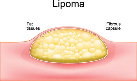 Lipomas - familydoctor.org