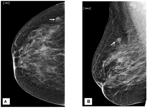 Liposarcoma breast. .  <a href=http://www.progresofarms.com/wp-includes/Requests/...