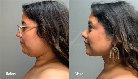 Liposuction cost orlando. If you are wondering how much chin liposuction can cost in Miami, know that the price of the procedure varies depending on the clinic and the type of liposuction performed. Some surgeons charge a flat fee, while others charge by the amount of fat removed. Typically, the average cost for a chin lipo ranges from $2,000 to $8,000. 