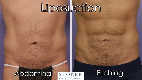 Liposuction for Men Before and After Pictures - Dr. David Stoker